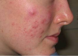 acne_face.jpg