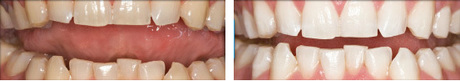 before-after-teeth-whitening2.jpg