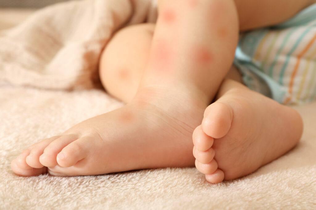 Protect your newborn from mosquito bites.